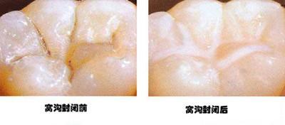 牙齿神经痛怎么治_牙齿神经痛怎么治较彻底(图2)