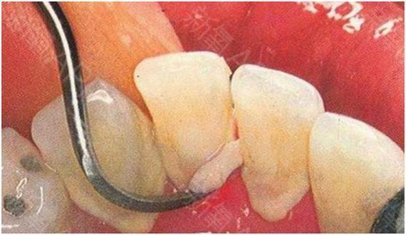 牙龈发炎肿痛怎么办—口腔牙龈发炎肿痛怎么办