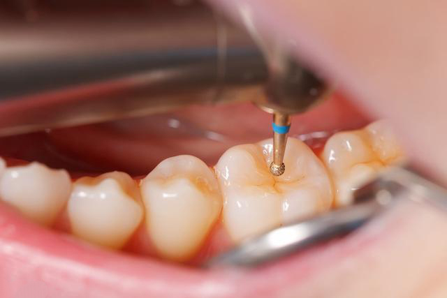 牙结石怎么清理;牙结石怎么清理好(图2)