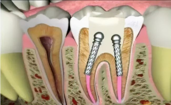 根管治疗怎么做_根管治疗怎么做的过程视频(图2)