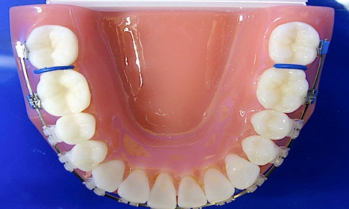 牙齿突出怎么矫正-牙齿突出怎么矫正需要拔牙吗(图2)