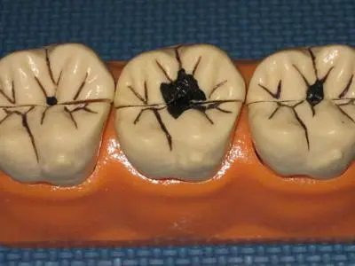 牙髓炎怎么治_牙髓炎怎么治疗较有效