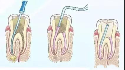 牙龈老出血怎么回事_怀孕后牙龈老出血怎么回事