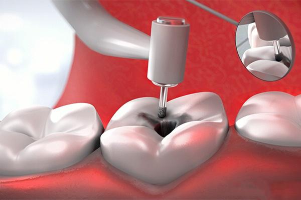 拔牙后旁边的牙疼怎么回事;拔牙后旁边的牙疼怎么回事会好吗(图3)