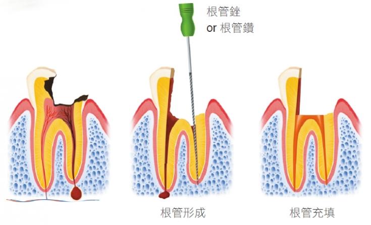 牙齿肿了怎么消肿，牙齿肿了怎么消肿热敷还是冷敷(图2)