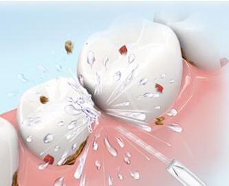 牙齿流血是怎么回事、牙齿流血是怎么回事？牙龈出血怎么治疗？