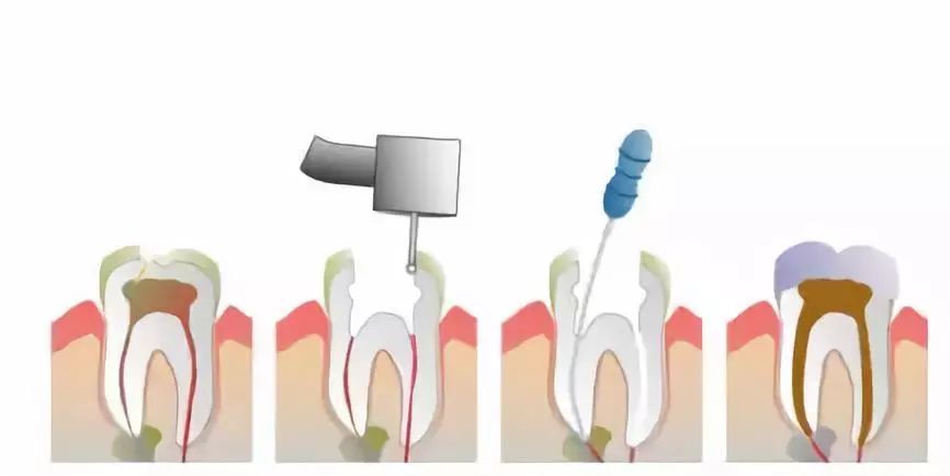 牙髓炎怎么引起的—牙髓炎怎么引起的图解修复咒语(图3)