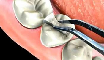 牙周炎怎么办—孩子牙周炎怎么办