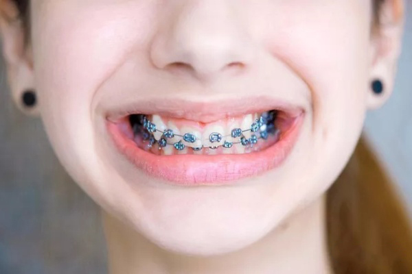 侧脸嘴巴突出怎么办—侧脸嘴巴突出怎么办女生