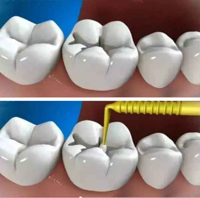 嘴凸怎么矫正;儿童骨性嘴凸怎么矫正(图3)