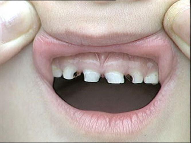 牙齿痛怎么快速止痛，牙齿痛怎么快速止痛药物