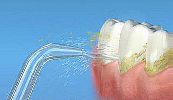 牙结石怎么处理，牙龈有牙结石怎么处理(图2)