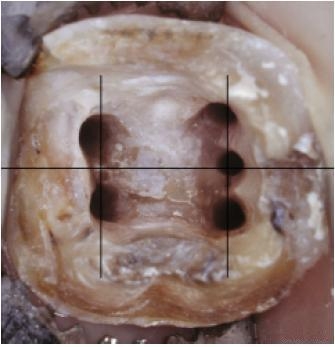 牙疼怎么止痛较快方法，牙疼怎么止痛较快方法图片