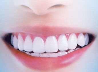 牙垢怎么去除(牙垢怎么去除妙招)