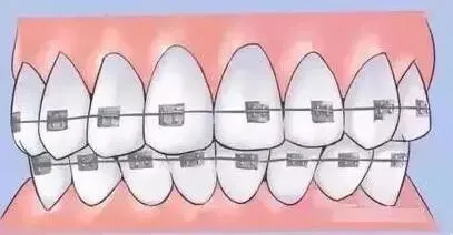 咬合不正怎么矫正，儿童牙齿咬合不正怎么矫正