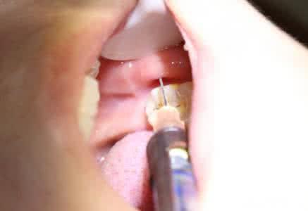 长智齿了牙龈肿痛怎么办;长智齿了牙龈肿痛怎么办缓解