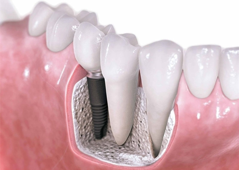 牙齿怎么种植视频—牙齿怎么种植视频全过程(图2)