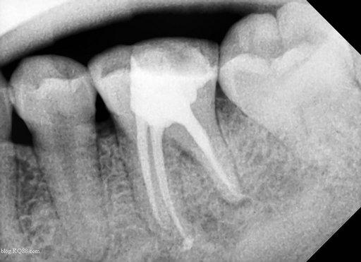 牙齿发炎怎么治疗;牙齿发炎怎么治疗吃盐