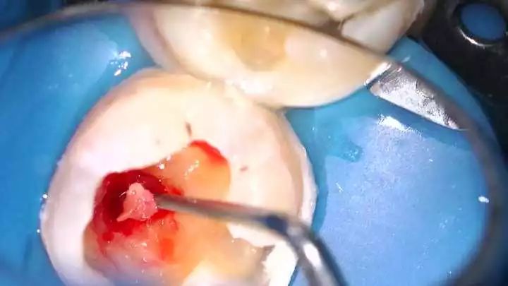 牙疼怎么治疗—牙疼怎么治疗较快止疼方法(图3)