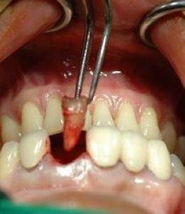 牙齿松动怎么办