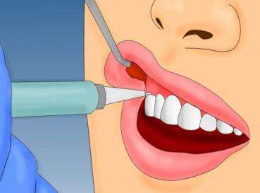 拔完智齿有个洞怎么办、拔完智齿有个洞怎么办多久能长好(图2)