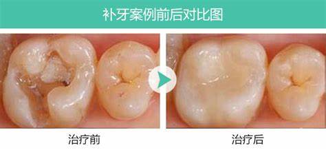 牙齿掉了一小块怎么办(龋齿牙齿掉了一小块怎么办)