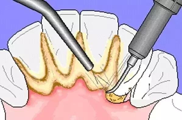牙龈肿痛怎么办_牙龈肿痛怎么办快速消肿(图3)