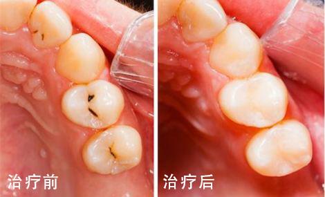 经常牙龈出血是怎么回事_经常牙龈出血是怎么回事会导致什么