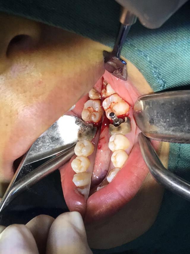 智齿疼怎么办—怀孕智齿疼怎么办(图2)