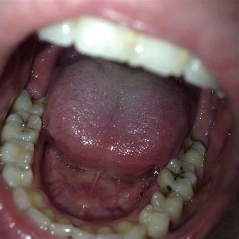 牙齿中间有缝怎么办;50岁牙齿中间有缝怎么办