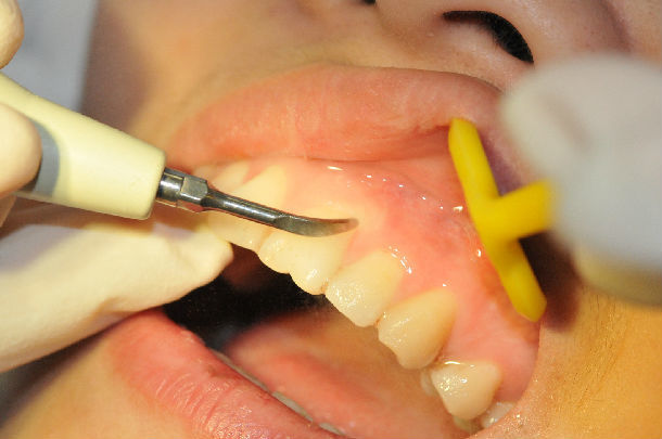 牙菌斑怎么去除;牙齿长牙菌斑怎么去除