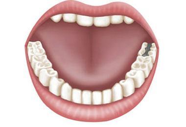 补牙怎么补;补牙怎么补法