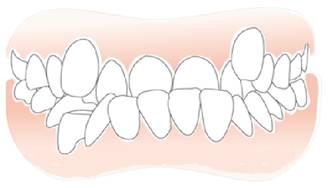 地包天怎么纠正;一岁半地包天怎么纠正(图2)
