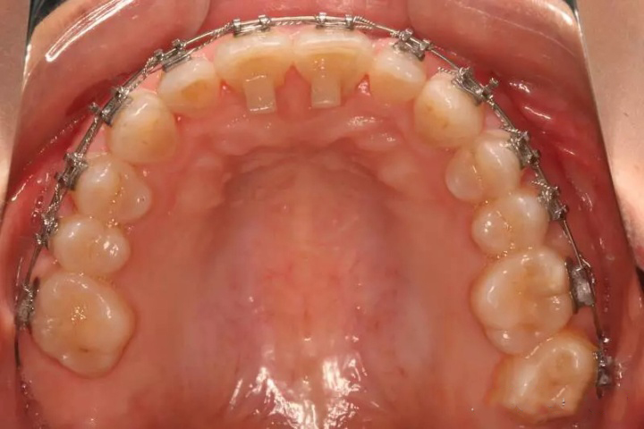 牙齿地包天怎么矫正_牙齿地包天怎么矫正方法