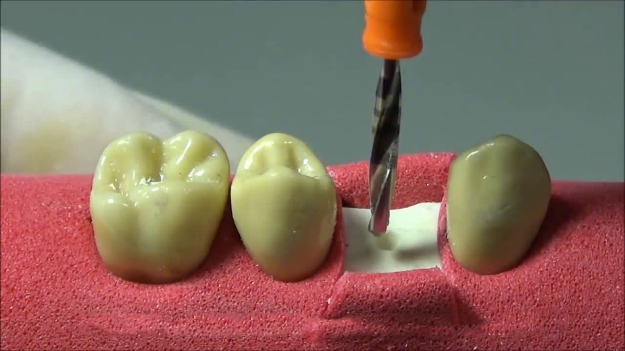 怎么拔牙_怎么拔牙较快而且不疼(图2)