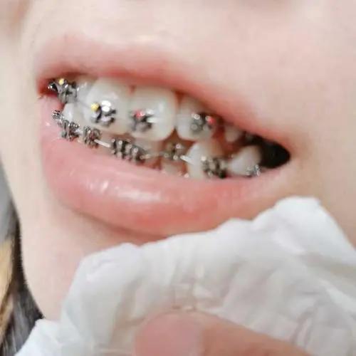 门牙缝隙大怎么办-牙齿门牙缝隙大怎么办(图2)