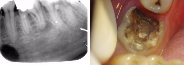 一到晚上就牙痛怎么回事_一到晚上就牙疼怎么回事