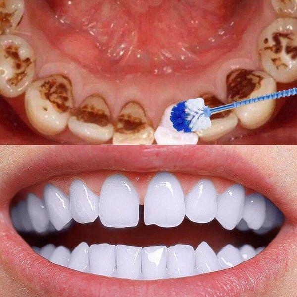 牙齿烟渍怎么去除-牙齿烟渍怎么去除知乎(图2)