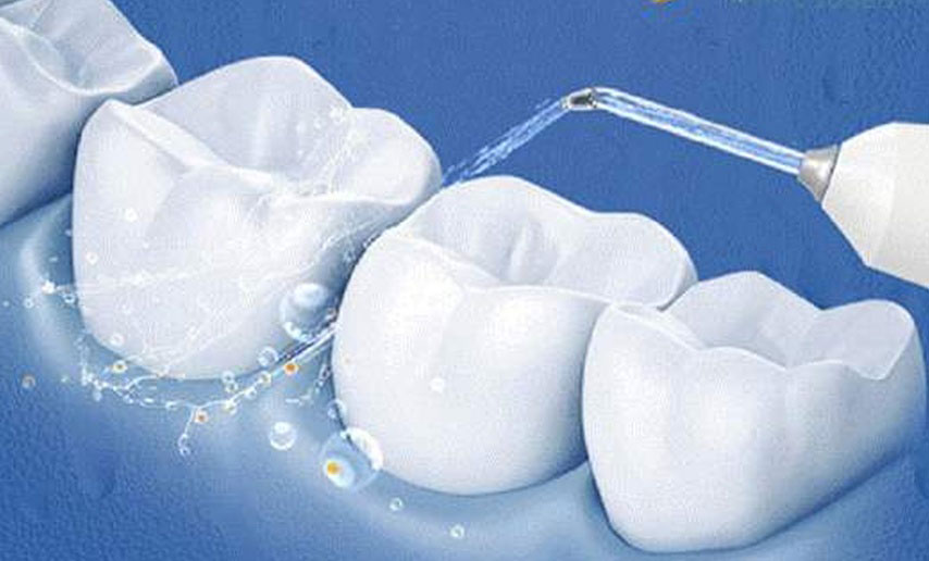 牙结石怎么处理，牙龈有牙结石怎么处理(图3)