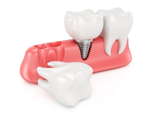 门牙掉了怎么办(成人大门牙掉了怎么办)(图2)