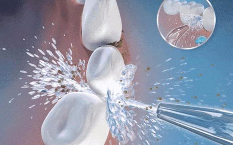 牙结石怎么办—牙结石怎么办较简单方法(图2)