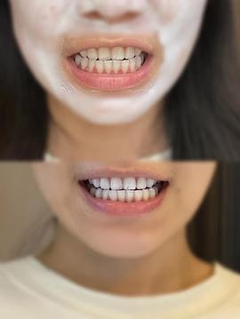 牙黄是怎么回事、上火牙黄是怎么回事