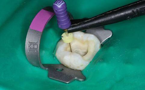 牙隐裂怎么办—牙隐裂怎么办可以修复吗