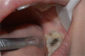 拔牙脸肿了怎么快速消肿;拔牙脸肿了怎么快速消肿偏方