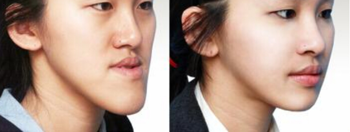 地包天怎么形成的,地包天怎么形成的?(图2)