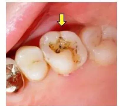 牙齿有个洞怎么办，牙齿有个洞怎么办不痛(图3)