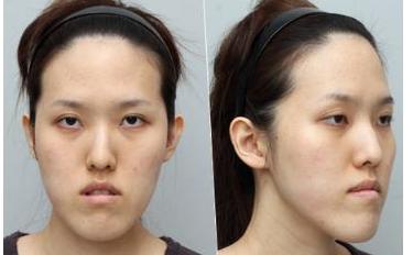 地包天怎么形成的，地包天怎么形成的？