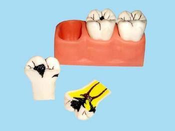 补牙是怎么补的(补牙是怎么补的呀)(图3)