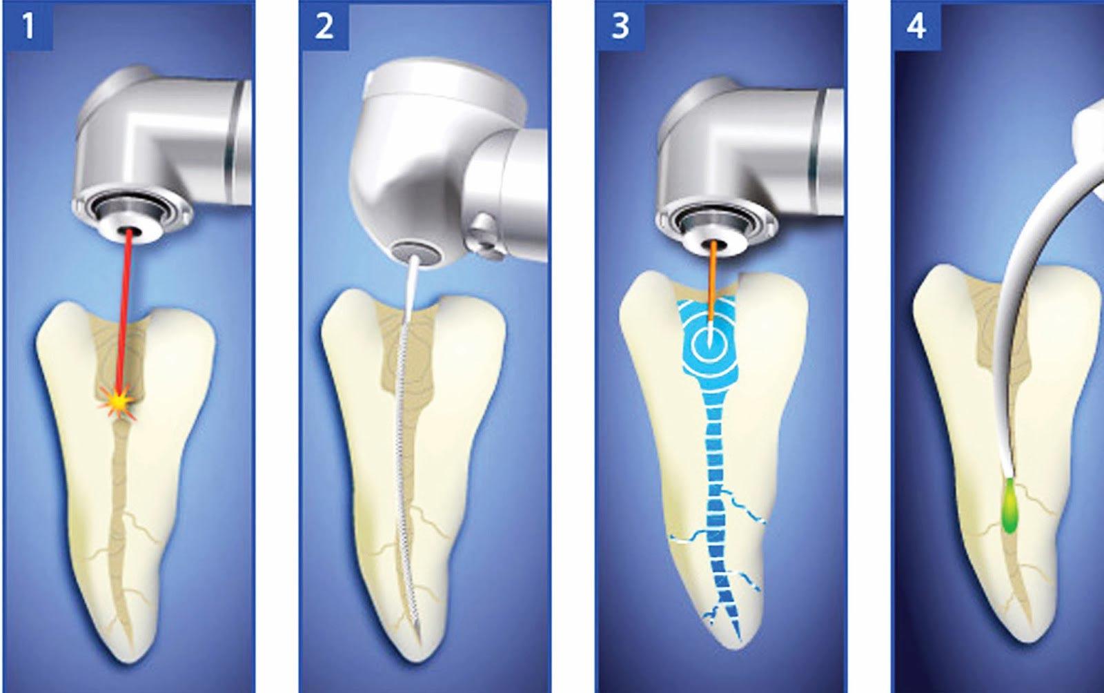 急性根尖周炎怎么治疗-急性根尖周炎怎么治疗吃什么药(图2)