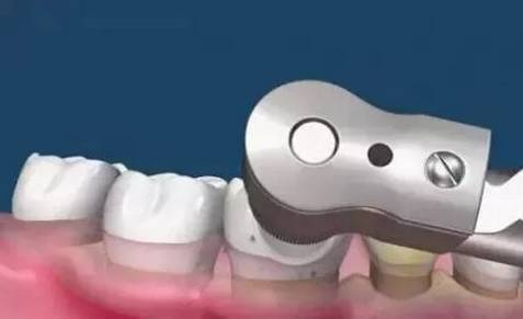 牙龈肿痛怎么办_牙龈肿痛怎么办快速消肿